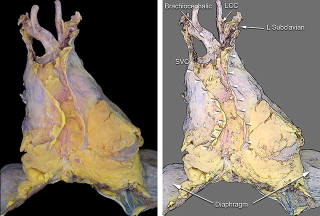 Adult pericardium sternopericardial ligaments